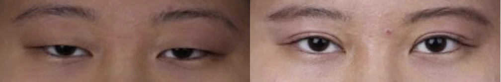 Incisional double-eyelid surgery — before on the left and after on the right at Afternoon Plastic Surgery
