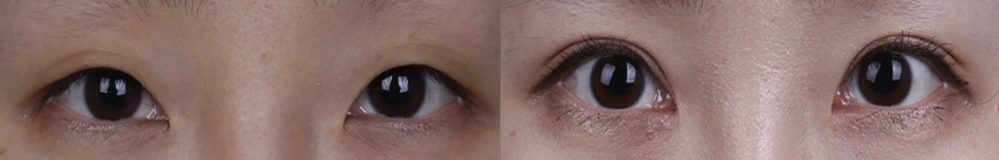 Incisional double-eyelid surgery — before on the left and after on the right at Afternoon Plastic Surgery