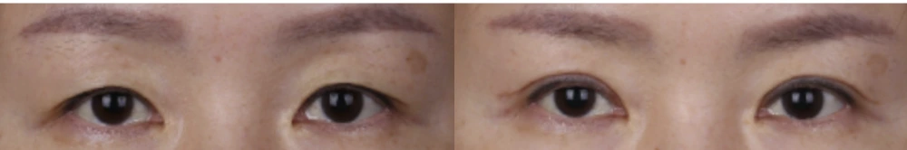 Incisional double-eyelid surgery — before on the left and after on the right at Afternoon Plastic Surgery
