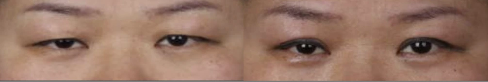 Incisional double-eyelid surgery — before on the left and after on the right at Afternoon Plastic Surgery