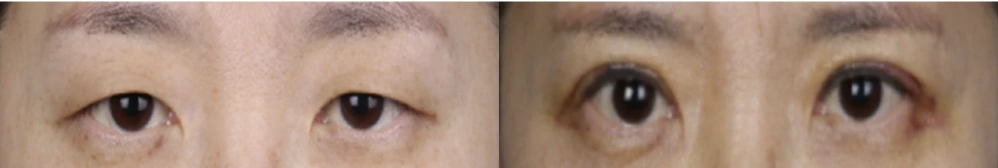 Incisional double-eyelid surgery — before on the left and after on the right at Afternoon Plastic Surgery