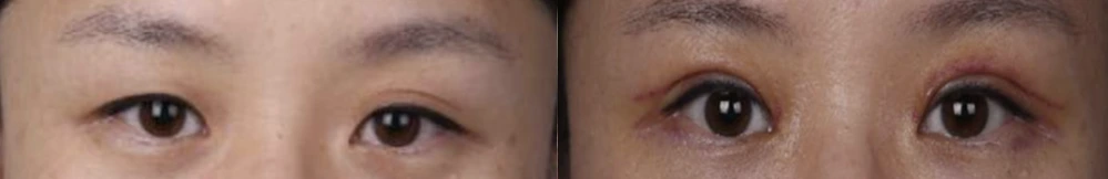 Incisional double-eyelid surgery — before on the left and after on the right at Afternoon Plastic Surgery