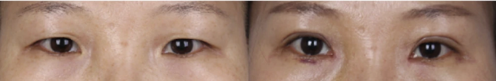 Incisional double-eyelid surgery — before on the left and after on the right at Afternoon Plastic Surgery