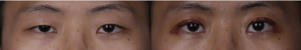 Incisional double-eyelid surgery — before on the left and after on the right at Afternoon Plastic Surgery