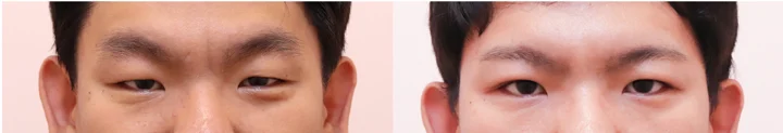 Men’s incisional eyelid correction before and after at Afternoon Plastic Surgery