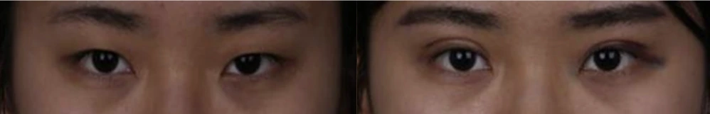 Non-incisional double-eyelid surgery — before on the left and after on the right at Afternoon Plastic Surgery