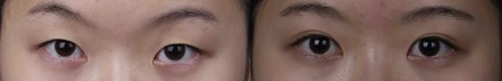 Non-incisional double-eyelid surgery — before on the left and after on the right at Afternoon Plastic Surgery