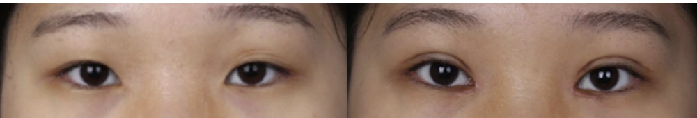 Non-incisional double-eyelid surgery — before on the left and after on the right at Afternoon Plastic Surgery