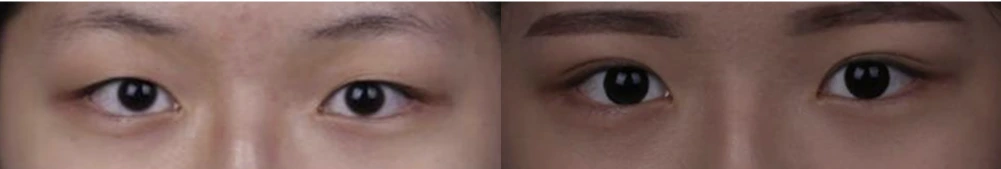 Non-incisional double-eyelid surgery — before on the left and after on the right at Afternoon Plastic Surgery