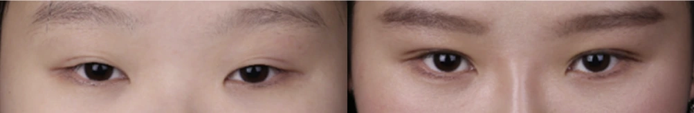 Non-incisional double-eyelid surgery — before on the left and after on the right at Afternoon Plastic Surgery