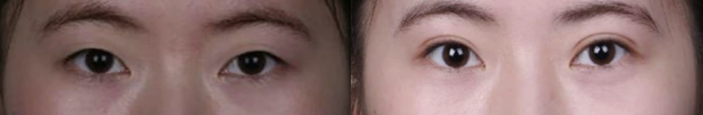 Non-incisional double-eyelid surgery — before on the left and after on the right at Afternoon Plastic Surgery