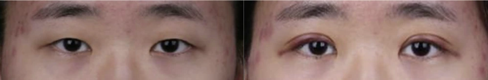 Non-incisional double-eyelid surgery — before on the left and after on the right at Afternoon Plastic Surgery