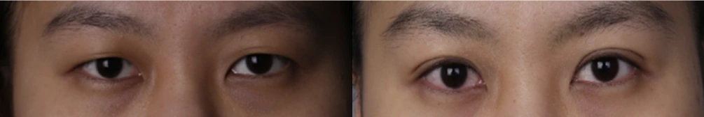Non-incisional double-eyelid surgery — before on the left and after on the right at Afternoon Plastic Surgery