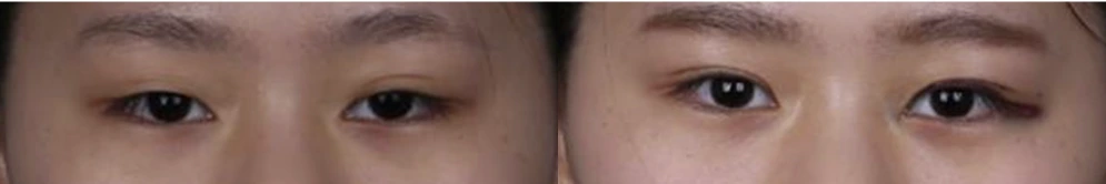 Non-incisional double-eyelid surgery — before on the left and after on the right at Afternoon Plastic Surgery