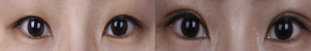 Non-incisional double-eyelid surgery — before on the left and after on the right at Afternoon Plastic Surgery