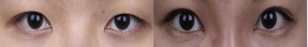 Non-incisional double-eyelid surgery — before on the left and after on the right at Afternoon Plastic Surgery