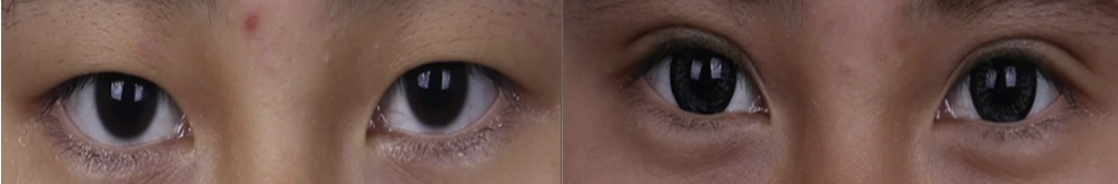 Non-incisional double-eyelid surgery — before on the left and after on the right at Afternoon Plastic Surgery
