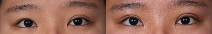 Revision to raise the left eyelid crease before and after at Afternoon Plastic Surgery