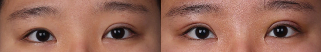Revision to raise the left eyelid crease — before on the left and after on the right at Afternoon Plastic Surgery