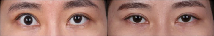 Revision of overcorrected eyelid opening before and after at Afternoon Plastic Surgery