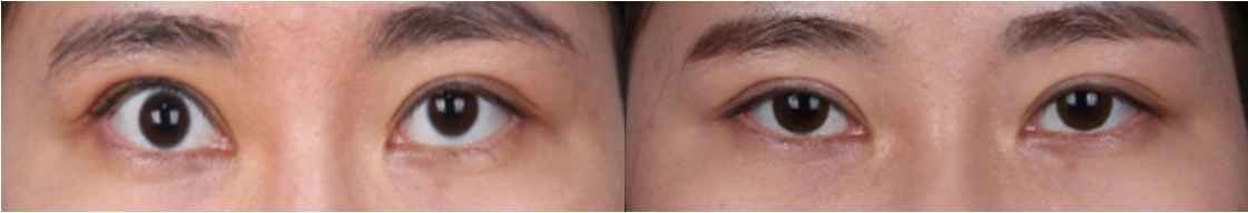 Revision of overcorrected eyelid opening — before on the left and after on the right at Afternoon Plastic Surgery