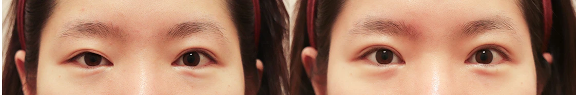 Loose eyelid crease with non-incisional eyelid correction — before on the left and after on the right at Afternoon Plastic Surgery