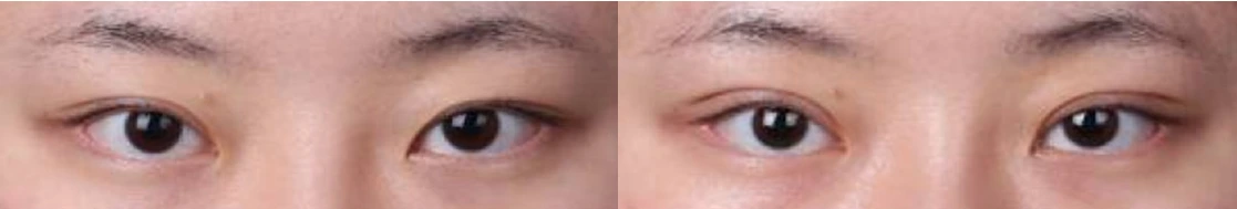 Non-incisional revision to raise the crease — before on the left and after on the right at Afternoon Plastic Surgery