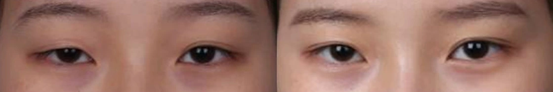 Non-incisional double-eyelid revision — before on the left and after on the right at Afternoon Plastic Surgery