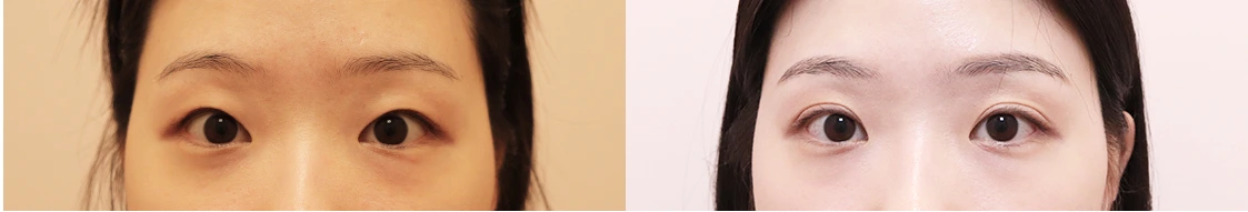 Incisional revision of a loosened eyelid crease — before on the left and after on the right at Afternoon Plastic Surgery