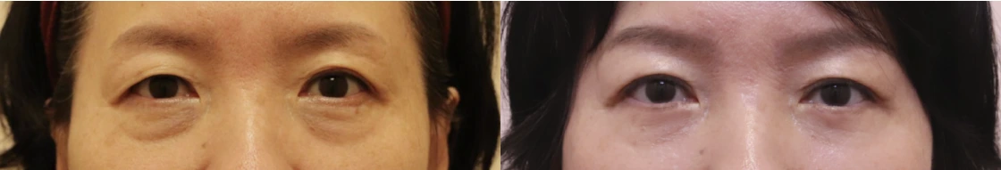 Lower-eyelid revision surgery — before on the left and after on the right at Afternoon Plastic Surgery