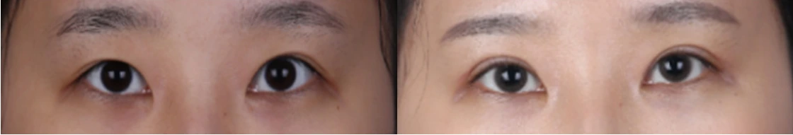 Revision of overcorrected eyelid opening — before on the left and after on the right at Afternoon Plastic Surgery