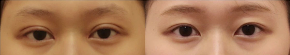 Revision to lower the eyelid crease — before on the left and after on the right at Afternoon Plastic Surgery
