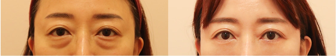 Lower-eyelid surgery — before on the left and after on the right at Afternoon Plastic Surgery