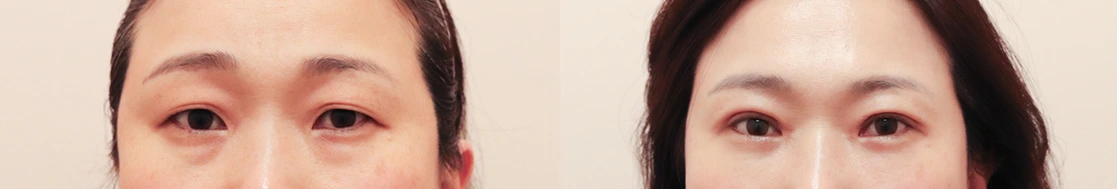 Upper-eyelid surgery with under-eye fat repositioning — before on the left and after on the right at Afternoon Plastic Surgery