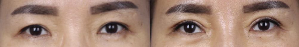 Upper-eyelid surgery — before on the left and after on the right at Afternoon Plastic Surgery