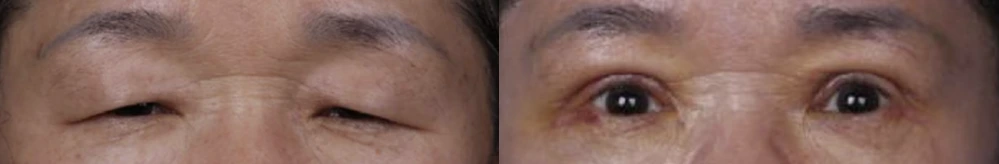 Upper-eyelid surgery with eyelid-opening correction — before on the left and after on the right at Afternoon Plastic Surgery