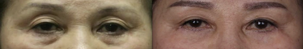 Eyelid surgery with upper-eyelid fat grafting — before on the left and after on the right at Afternoon Plastic Surgery