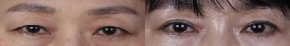 Upper-eyelid surgery — before on the left and after on the right at Afternoon Plastic Surgery