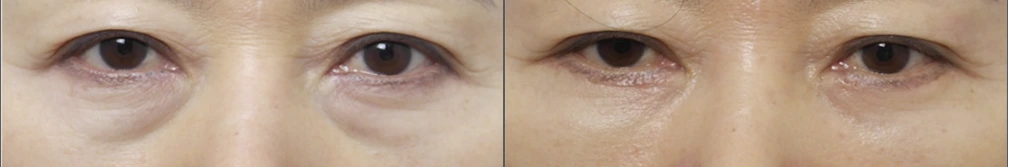 Lower-eyelid surgery — before on the left and after on the right at Afternoon Plastic Surgery