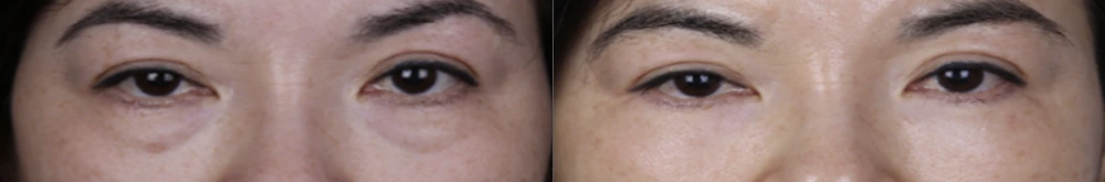 Lower-eyelid surgery — before on the left and after on the right at Afternoon Plastic Surgery