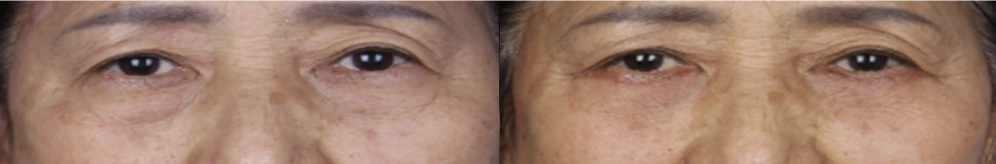 Lower-eyelid surgery — before on the left and after on the right at Afternoon Plastic Surgery