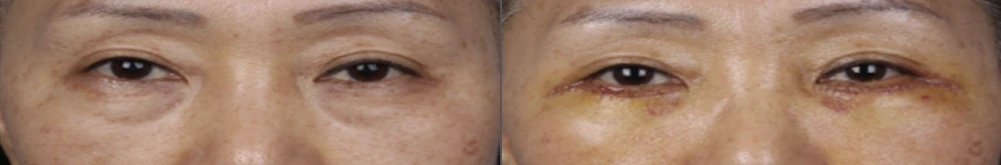 Lower-eyelid surgery — before on the left and after on the right at Afternoon Plastic Surgery