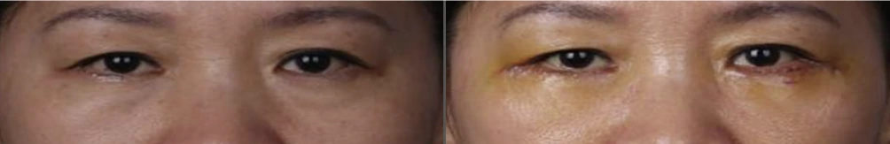 Lower-eyelid surgery — before on the left and after on the right at Afternoon Plastic Surgery