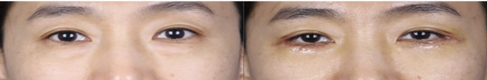 Lower-eyelid surgery — before on the left and after on the right at Afternoon Plastic Surgery