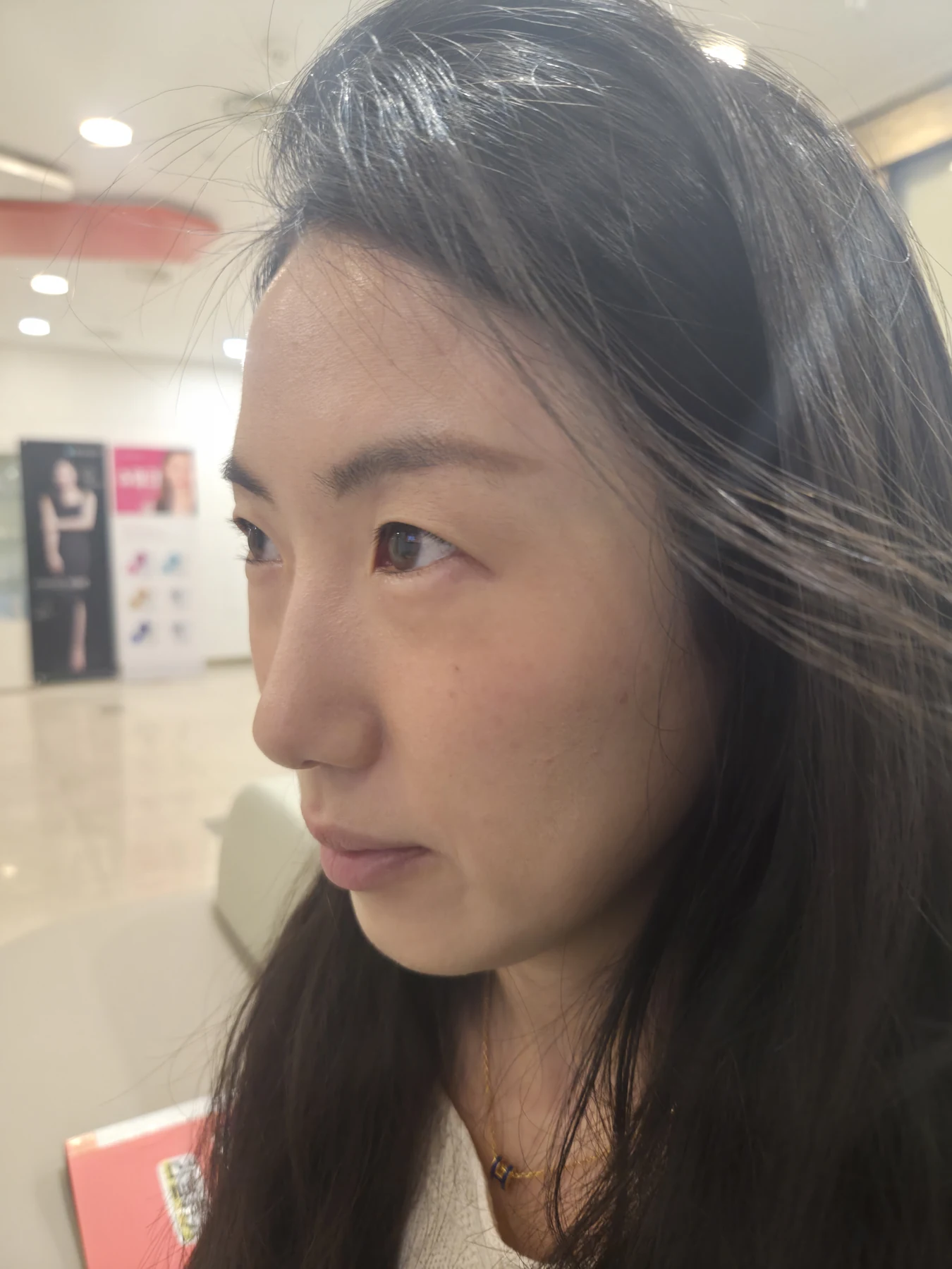 Wonder canthoplasty and under-eye fat repositioning: three-month photo diary · Case 058 at Answer Plastic Surgery. Angled view — before, wonder canthoplasty and under-eye fat repositioning at Answer Plastic Surgery (case 058).