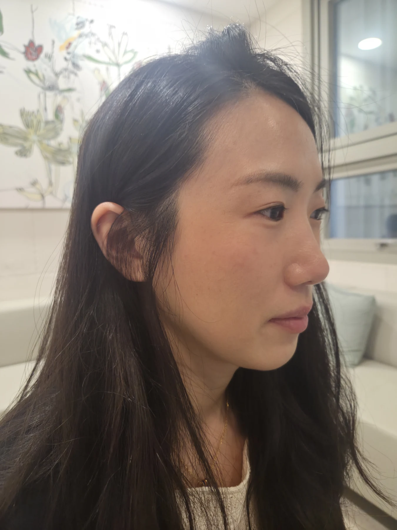 Wonder canthoplasty and under-eye fat repositioning: three-month photo diary · Case 058 at Answer Plastic Surgery. Angled view — before, wonder canthoplasty and under-eye fat repositioning at Answer Plastic Surgery (case 058).