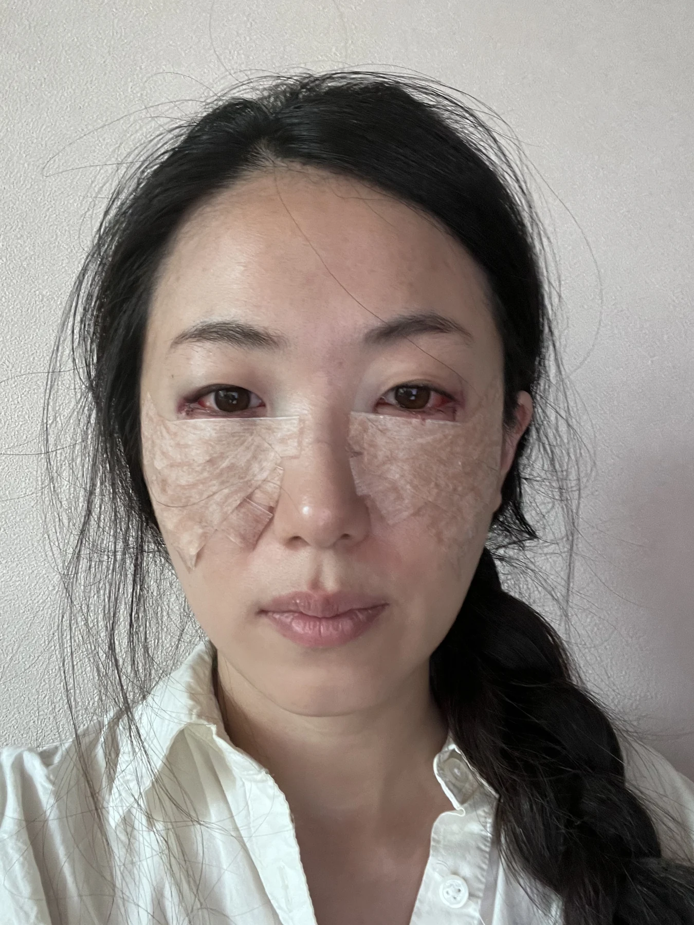 Wonder canthoplasty and under-eye fat repositioning: three-month photo diary · Case 058 at Answer Plastic Surgery. Front view — surgery day, wonder canthoplasty and under-eye fat repositioning at Answer Plastic Surgery (case 058).