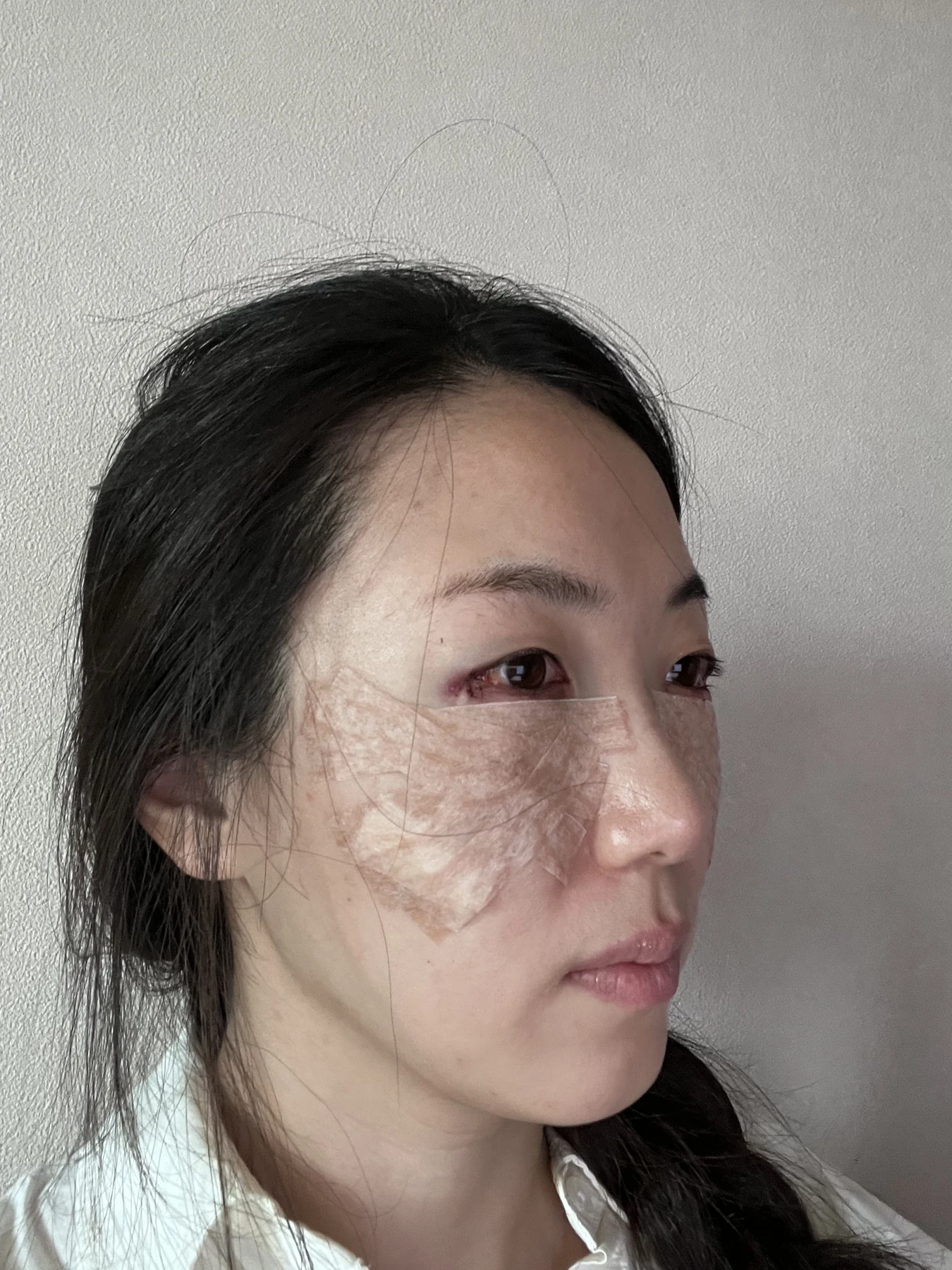 Wonder canthoplasty and under-eye fat repositioning: three-month photo diary · Case 058 at Answer Plastic Surgery. Angled view — surgery day, wonder canthoplasty and under-eye fat repositioning at Answer Plastic Surgery (case 058).