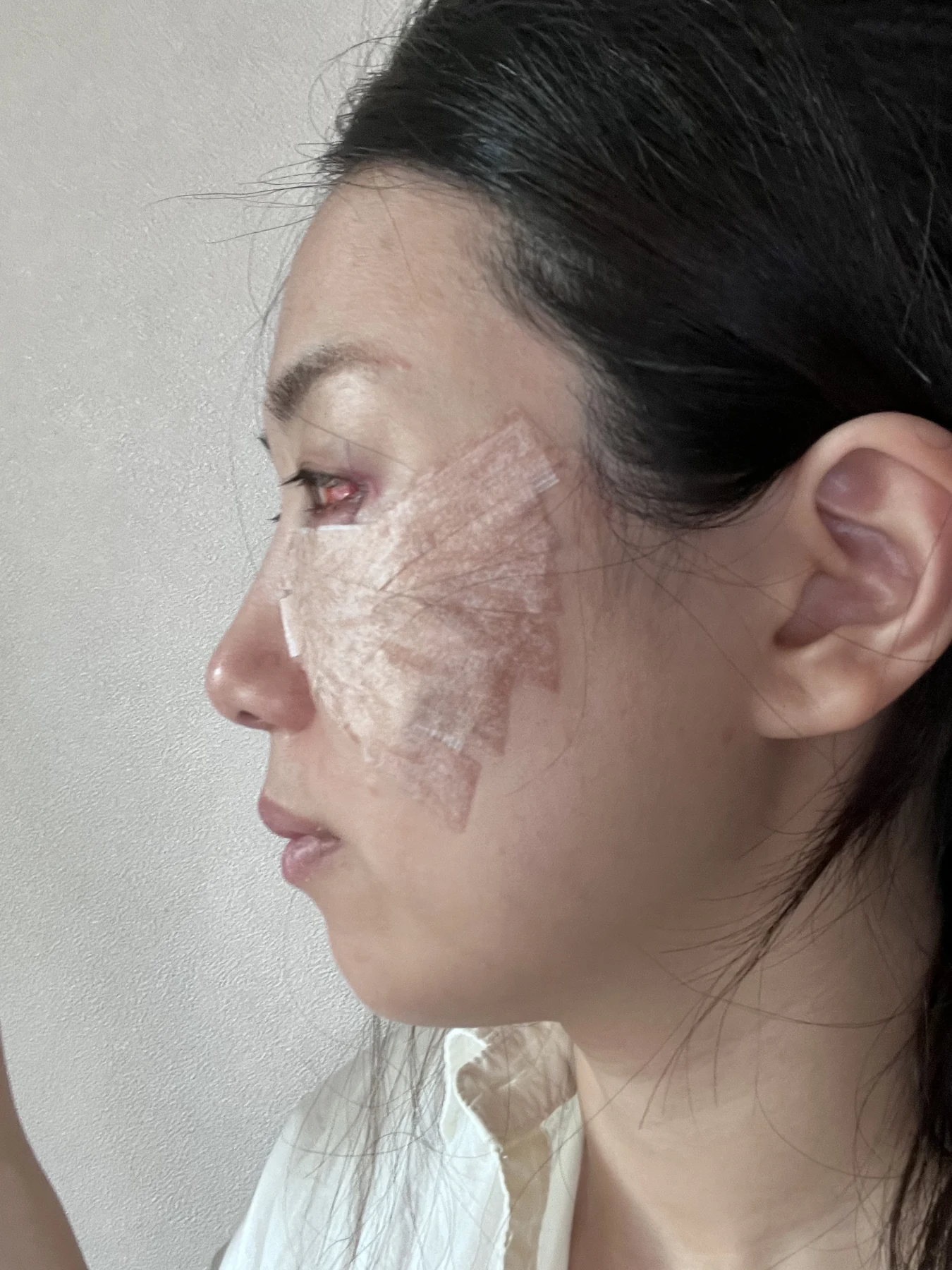 Wonder canthoplasty and under-eye fat repositioning: three-month photo diary · Case 058 at Answer Plastic Surgery. Angled view — surgery day, wonder canthoplasty and under-eye fat repositioning at Answer Plastic Surgery (case 058).