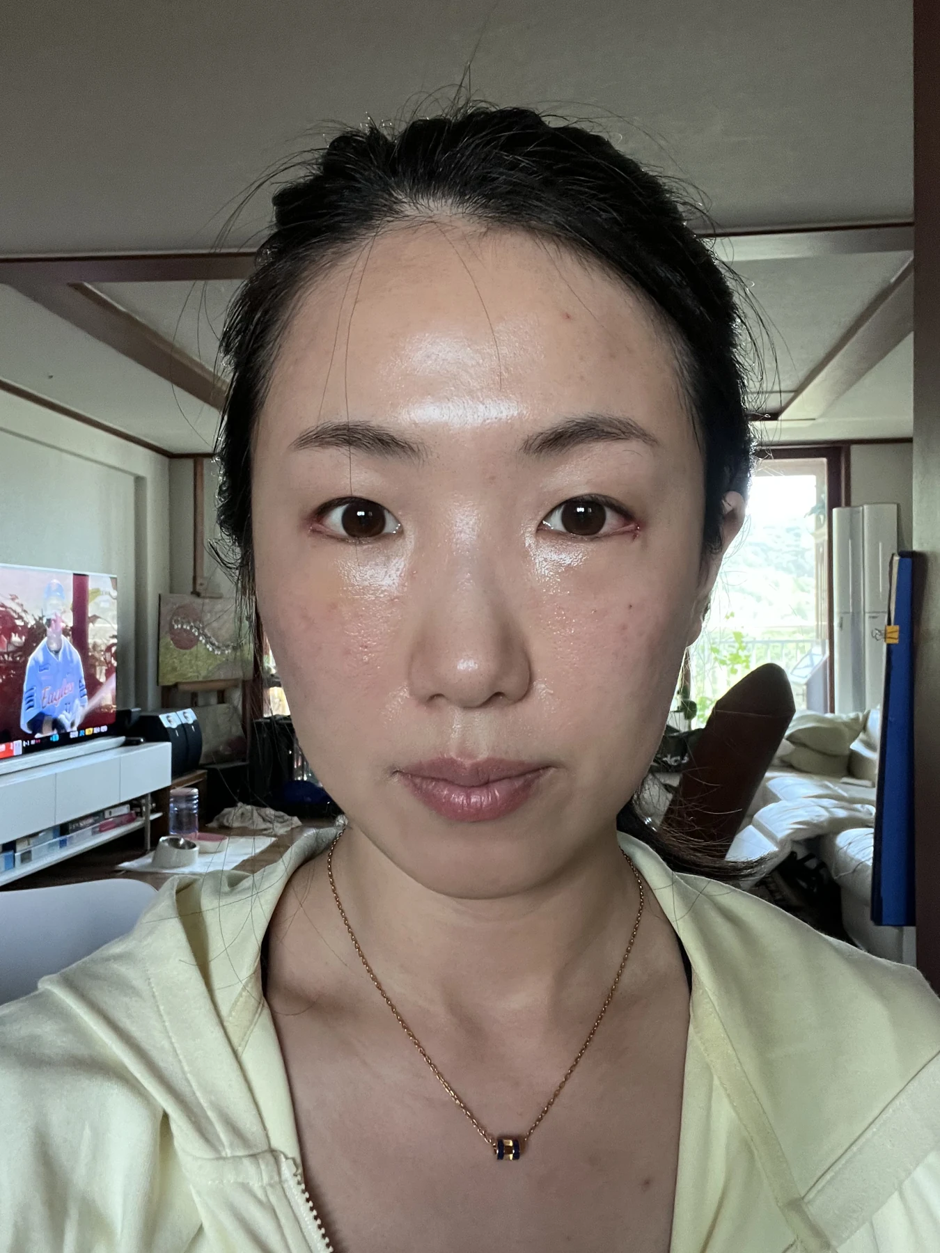 Wonder canthoplasty and under-eye fat repositioning: three-month photo diary · Case 058 at Answer Plastic Surgery. Front view — 1 week, wonder canthoplasty and under-eye fat repositioning at Answer Plastic Surgery (case 058).